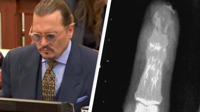 Surgeon Testifies That Depp's Severed Finger Story Is 'Inconsistent'