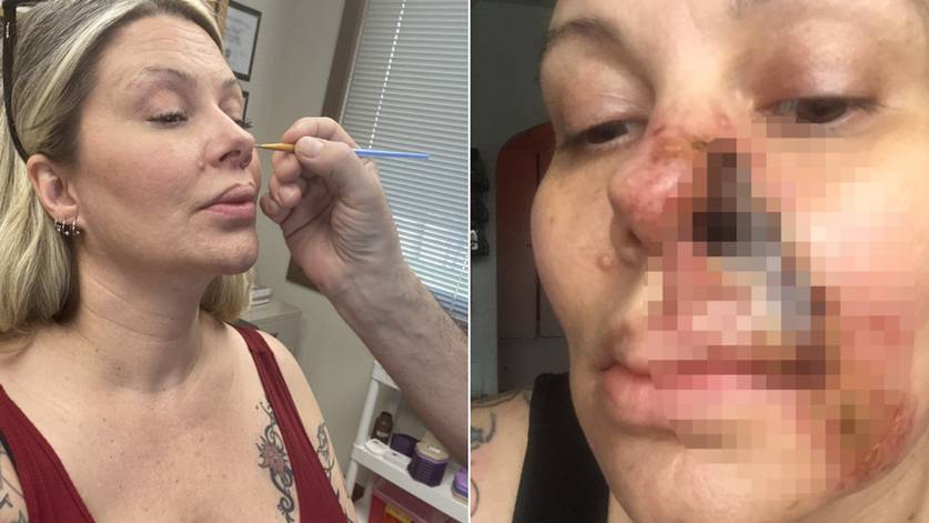 Woman horrified after filler to hide her 'ageing' smile lines made half her nose fall off