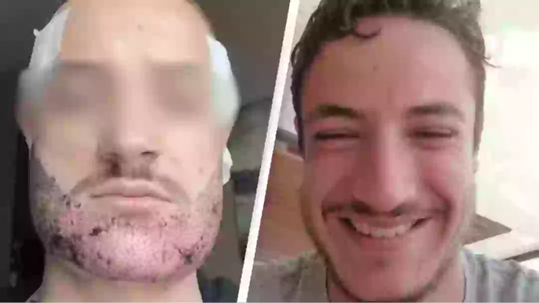 Botched Attempt Man dies by suicide after receiving botched beard transplant by 'estate ...