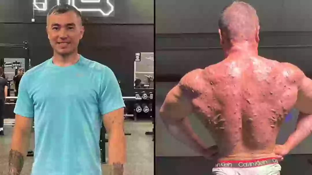 Bodybuilder shows off serious damage steroids have done to his body in ...