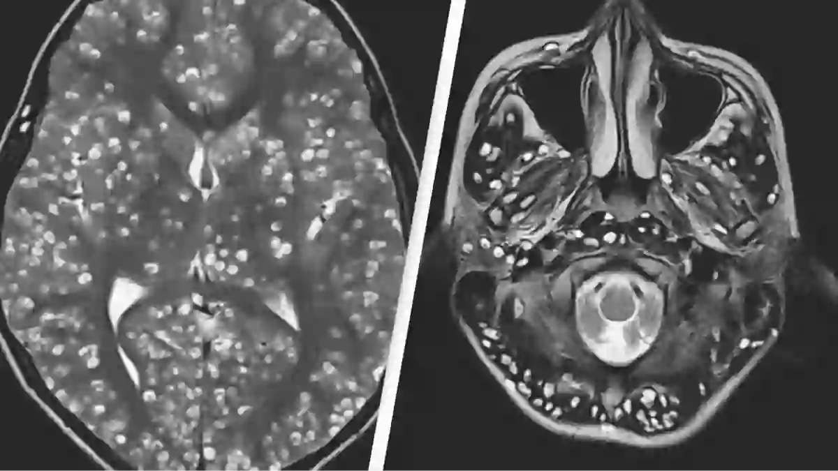 Brain Insect Parisite Animation Study finds 30% of Americans could be infected with brain parasite