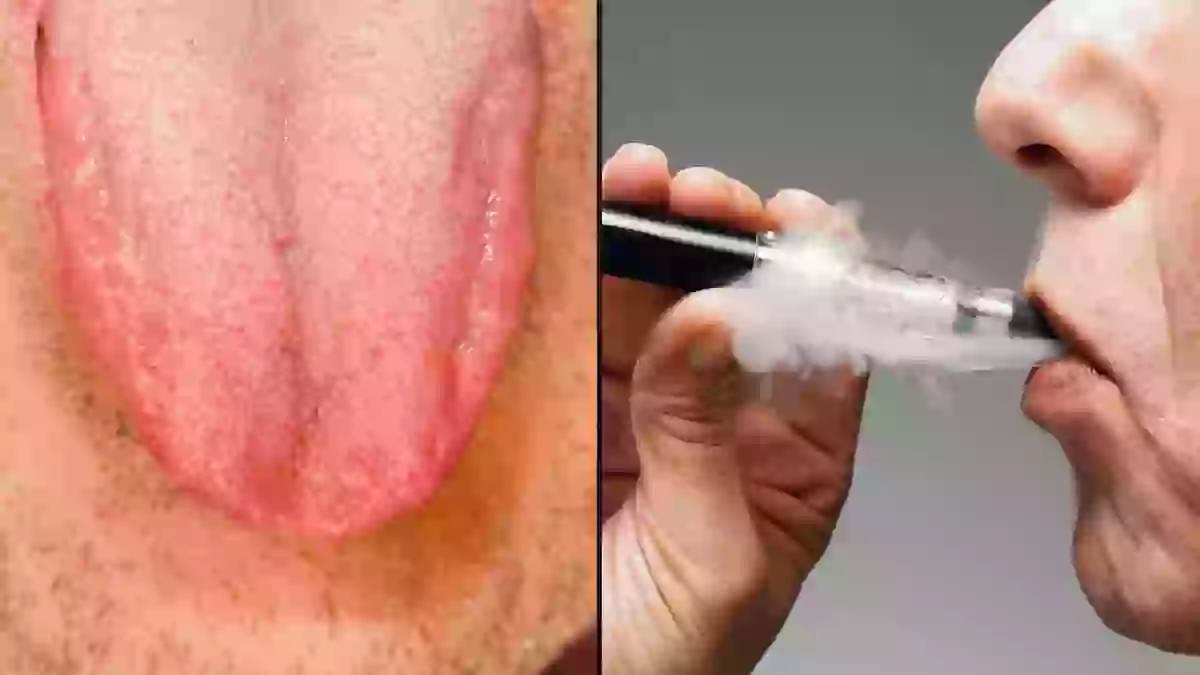 Vape Rashes Expert reveals shocking long-term side effect of ‘Vaper’s Tongue’ that ...