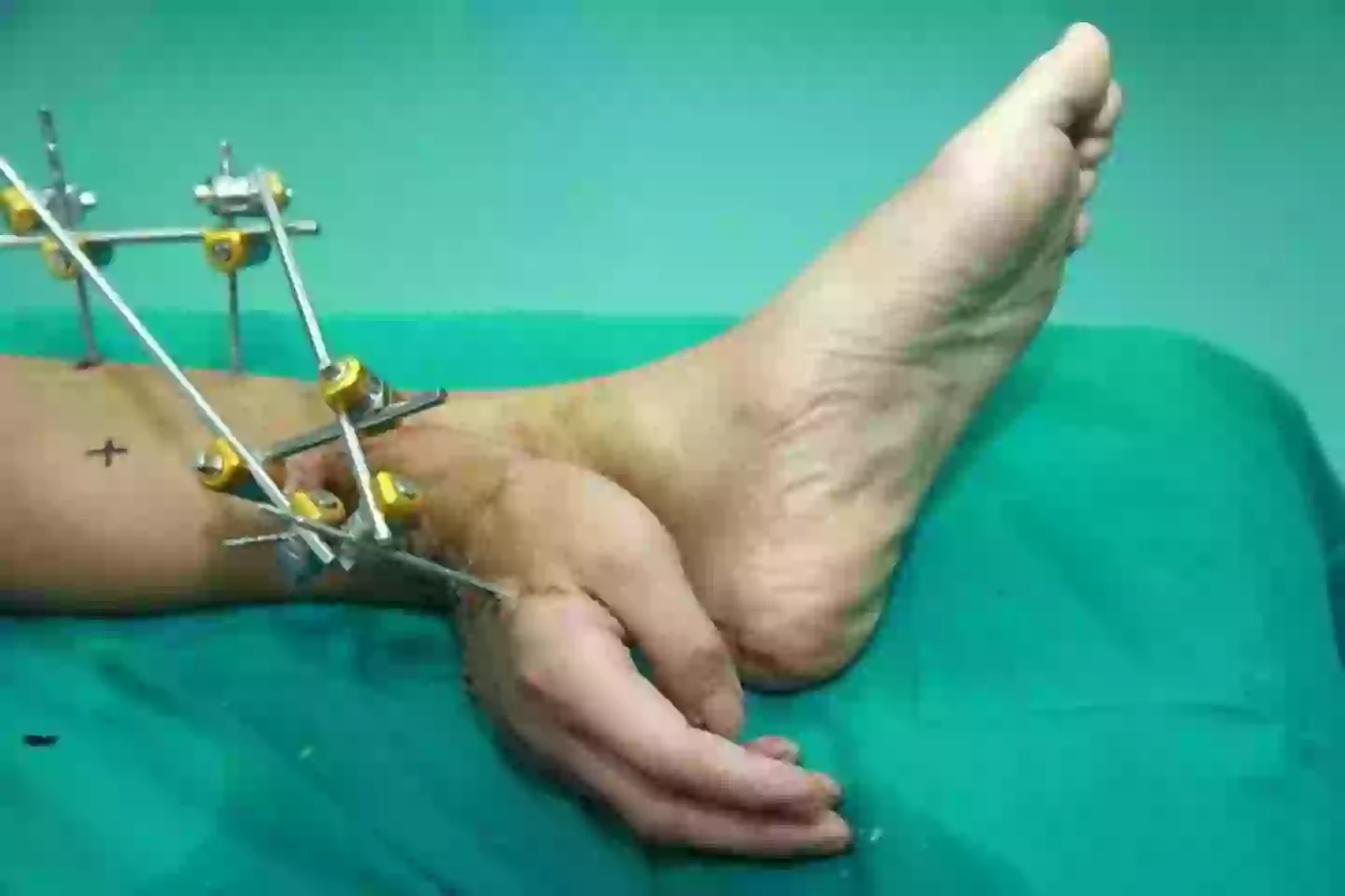 Later Hand Doctors in China attach man's hand to his ankle after it was cut off in ...