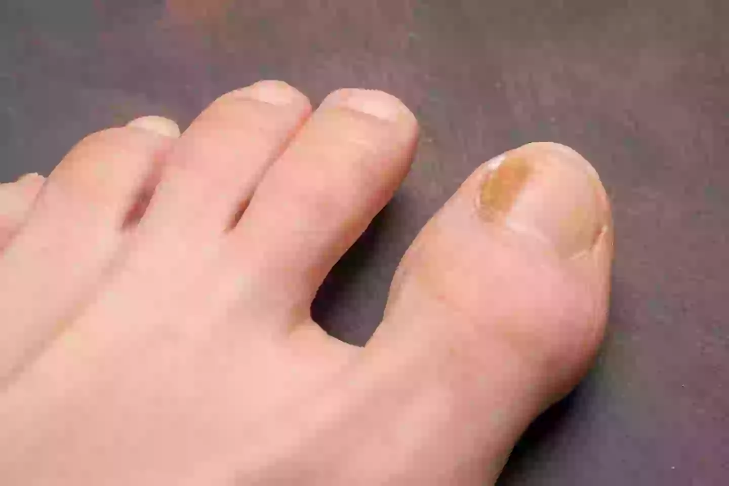 Doctors warn of little-known cancer symptom you can see on your toenails