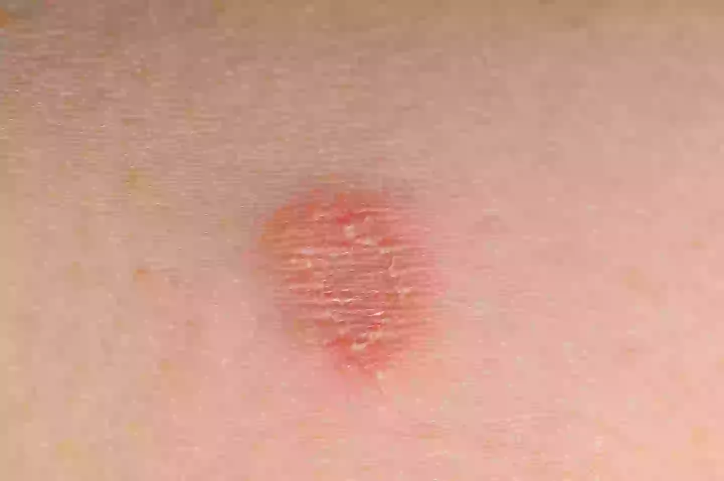 Ringworm Neck Rash Urgent health warning issued to Brits who get skin fades at barbers
