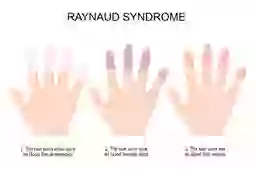 Hc Raynaud Raynaud's disease explained and why your fingers turn a different colour