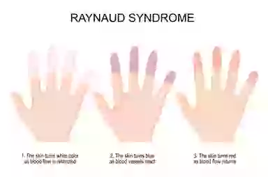 Hc Raynaud Raynaud's disease explained and why your fingers turn a different colour