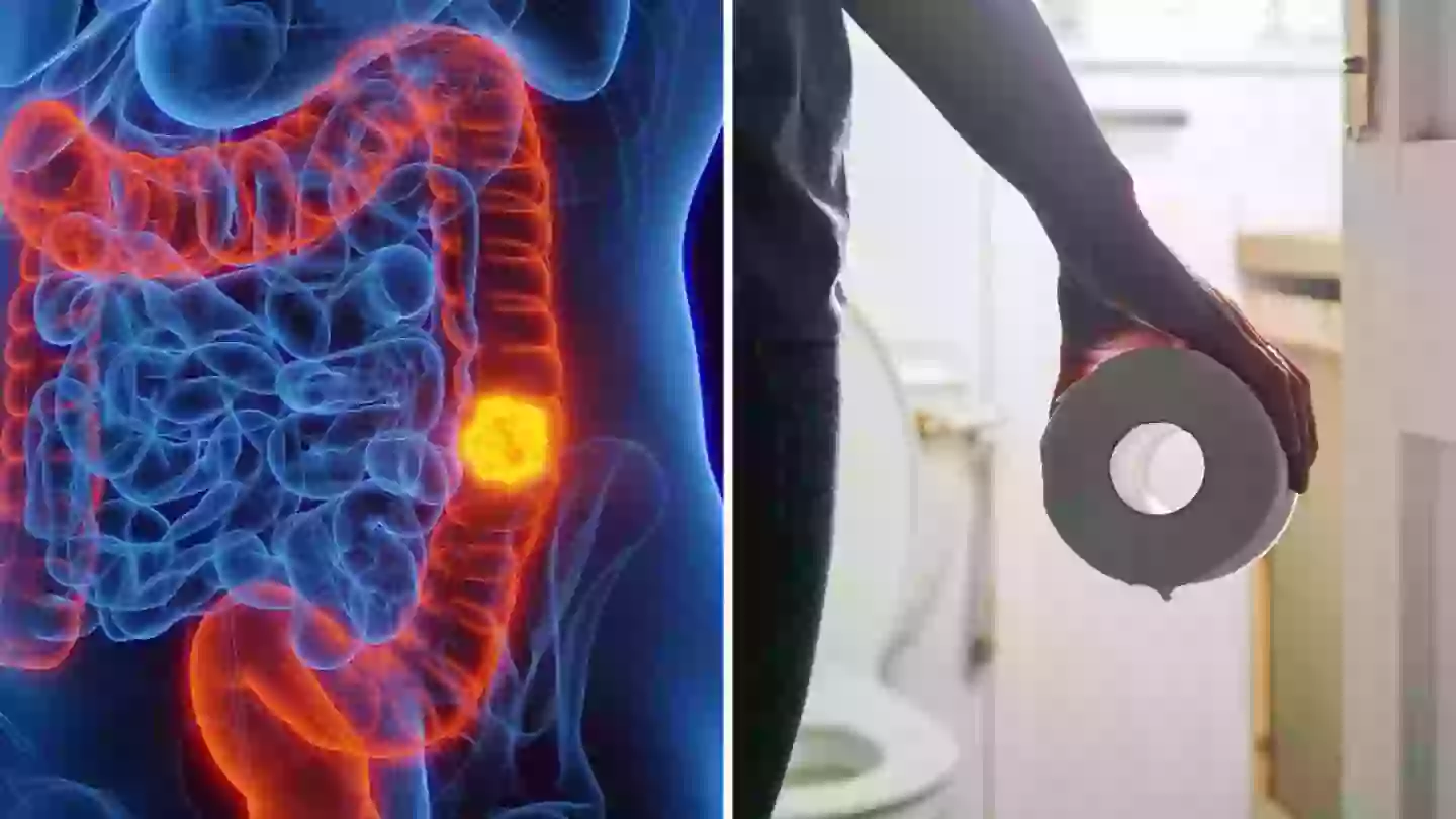 Doctor reveals crucial colon cancer self-check as cases surge for people under 50
