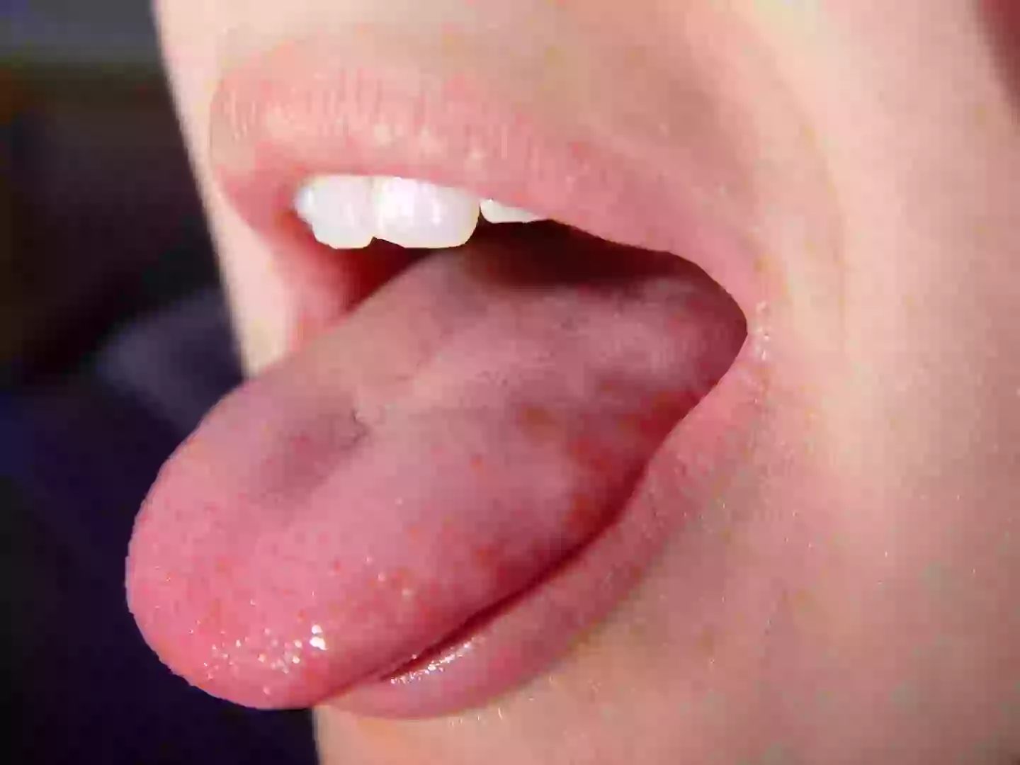 A doctor has given told us everything we need to know about those annoying 'tongue pimples' many of us get get from time to time (melking / Getty Images)