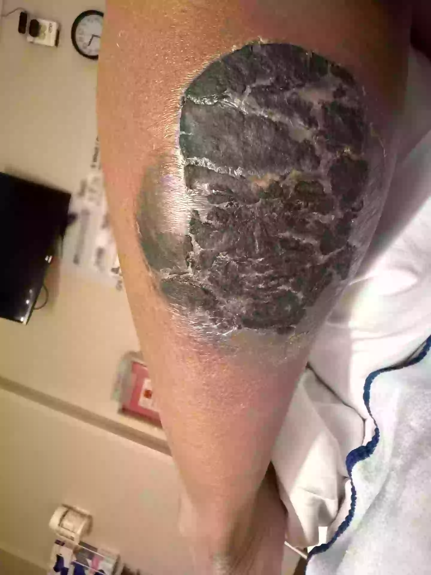 Following the infection and her hospital stay, the inking is now completely unrecognisable (Kennedy News and Media)