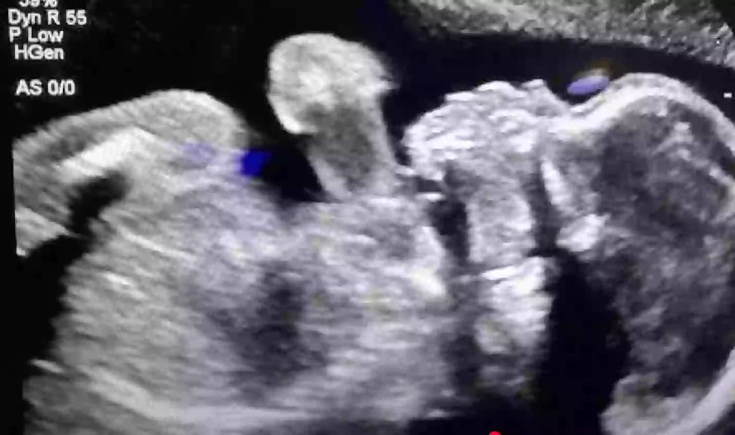 Doctors plan to induce the brain-dead woman, who is currently at 21 weeks, at 32 weeks along in her pregnancy (11 Alive)