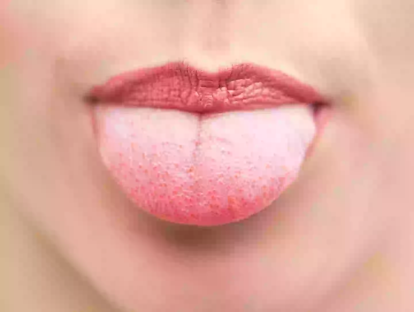 'Tongue pimples' are luckily not contagious (Wavebreakmedia Ltd / Getty Images)