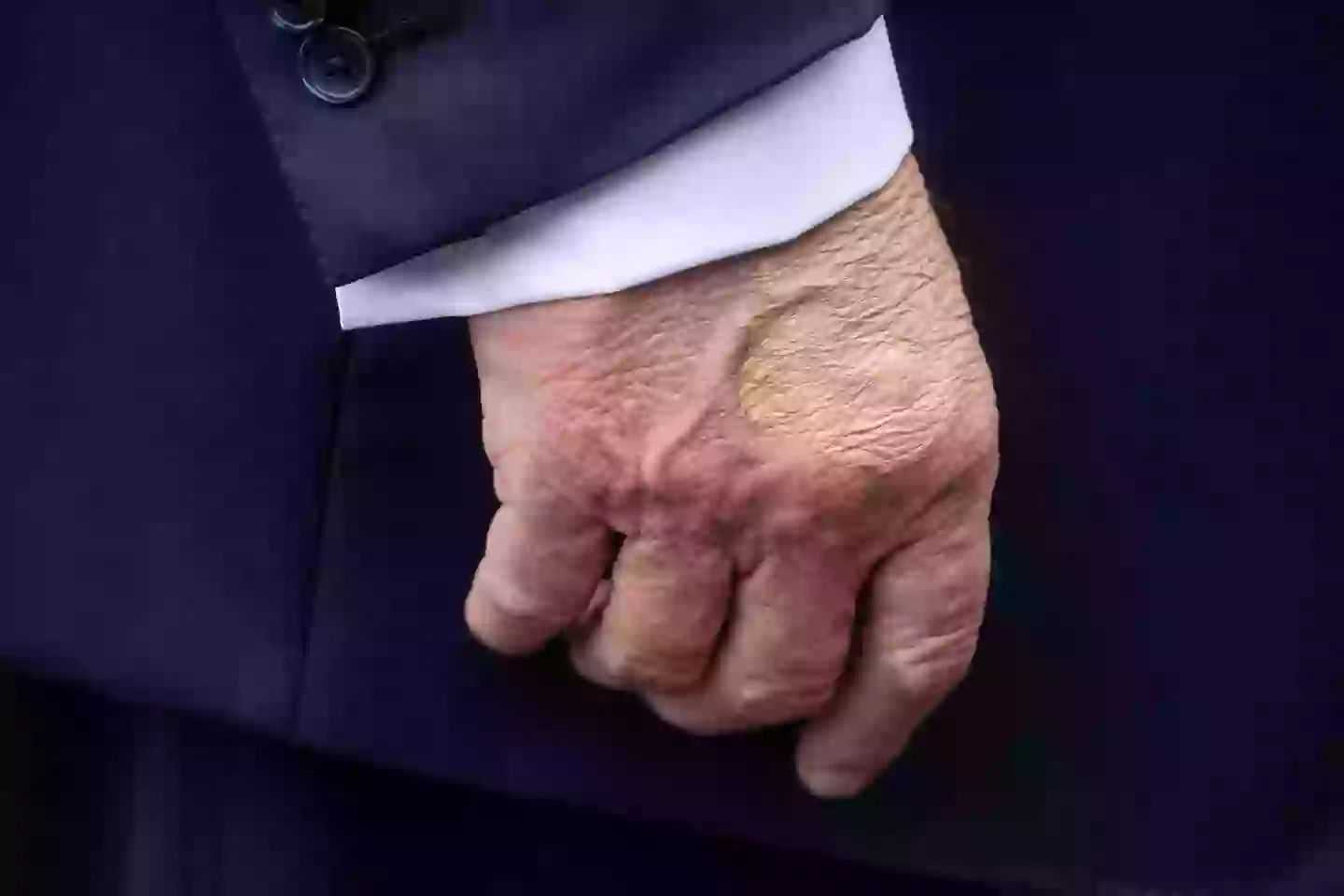 Trump's bruised hand has also caused a stir (JIM WATSON / Contributor / Getty Images)