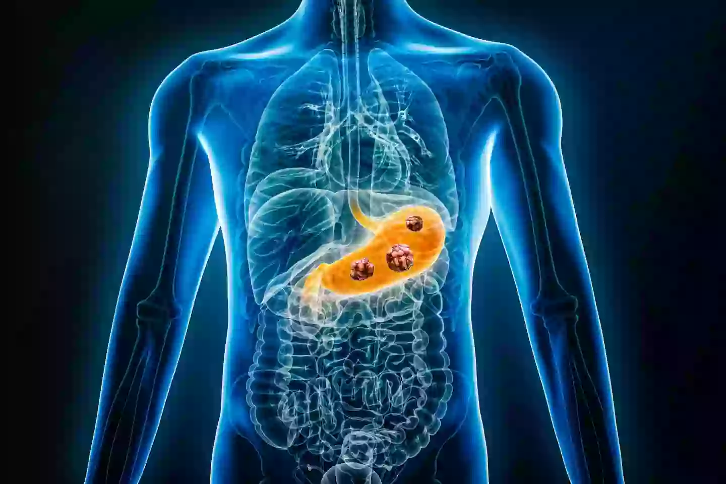 Not every case of stomach cancer presents with symptoms (Libre De Droit/Getty Images)