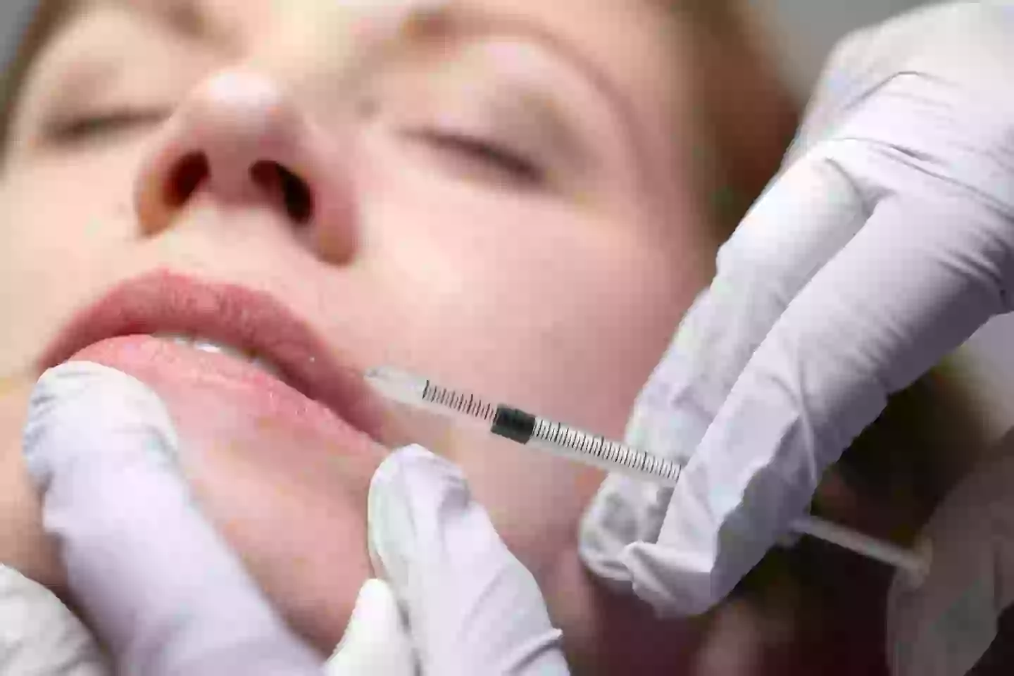 The study hopes to deter people from lip filler (Getty Images)