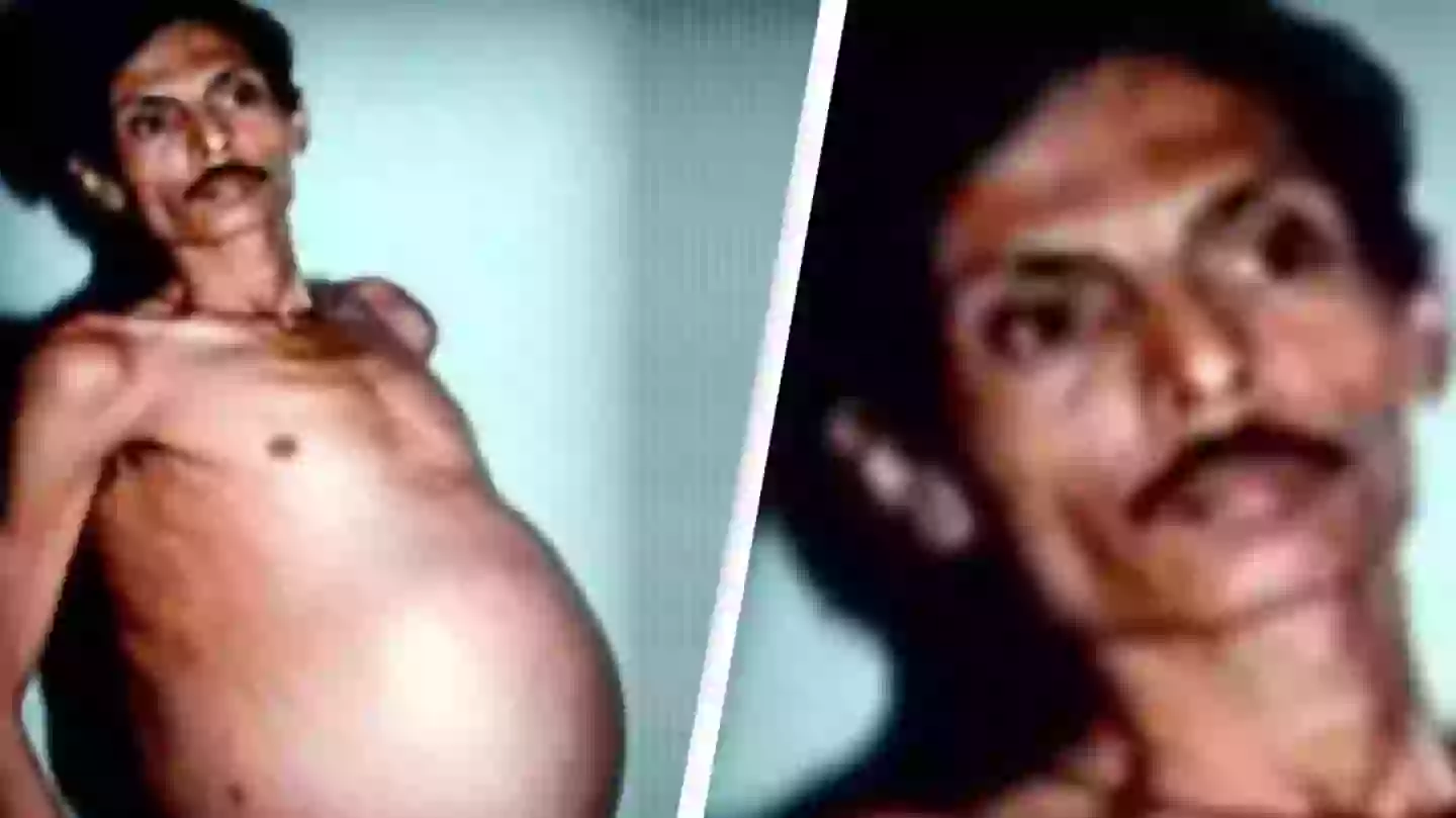 Man lived with twin inside him for 36 years without knowing