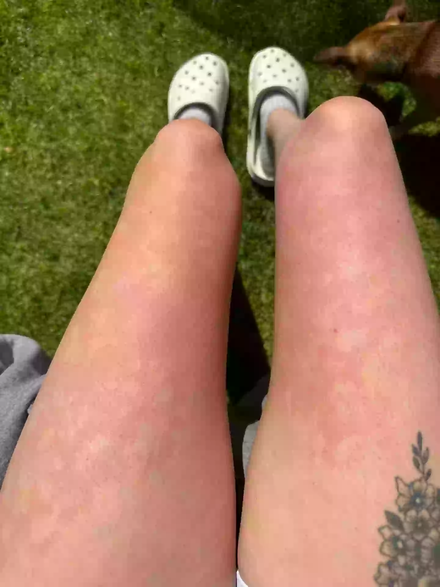 Bathing and rain water causes her skin to break out (Lee McLean/SWNS)
