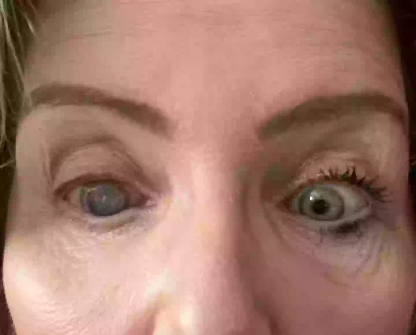 Maureen's eye ended up clouding over (Kennedy News and Media)