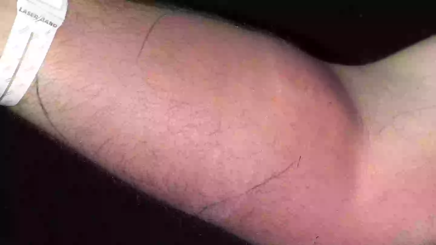 Man suffered horrifying side effects after injecting himself with own sperm to 'cure back pain'