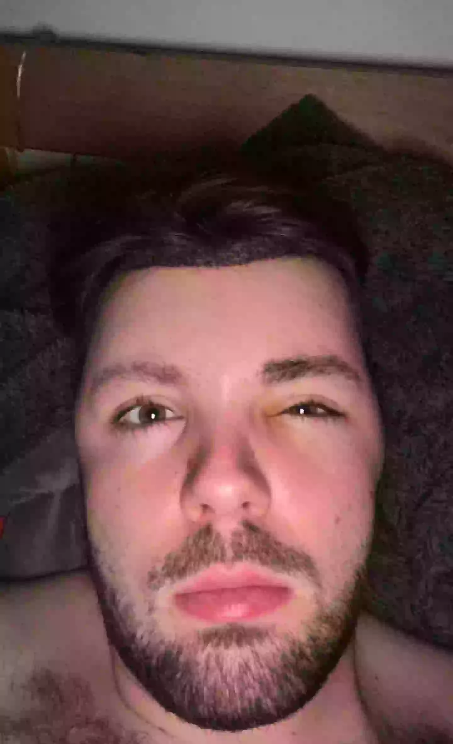 Owen was left with severe swelling after he ignored medical advice after a hair transplant (SWNS)