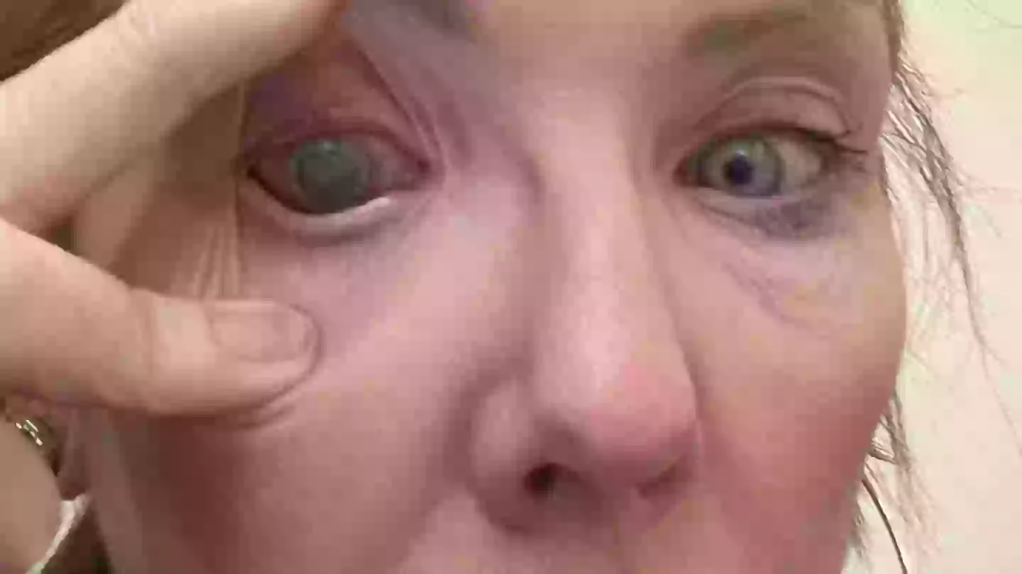 Woman left 'almost completely blind' in one eye after making common contact lens mistake