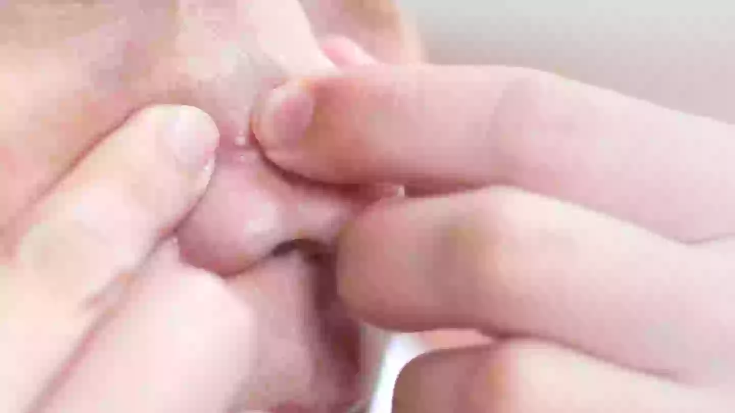 It's not a good idea to pop a spot in the triangle (Getty Stock Photo)