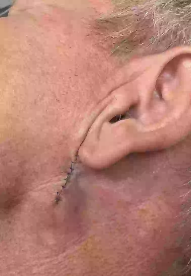 Gordon Ramsay shared a photo of the site where he had the cancer removed (gordongram/Instagram)