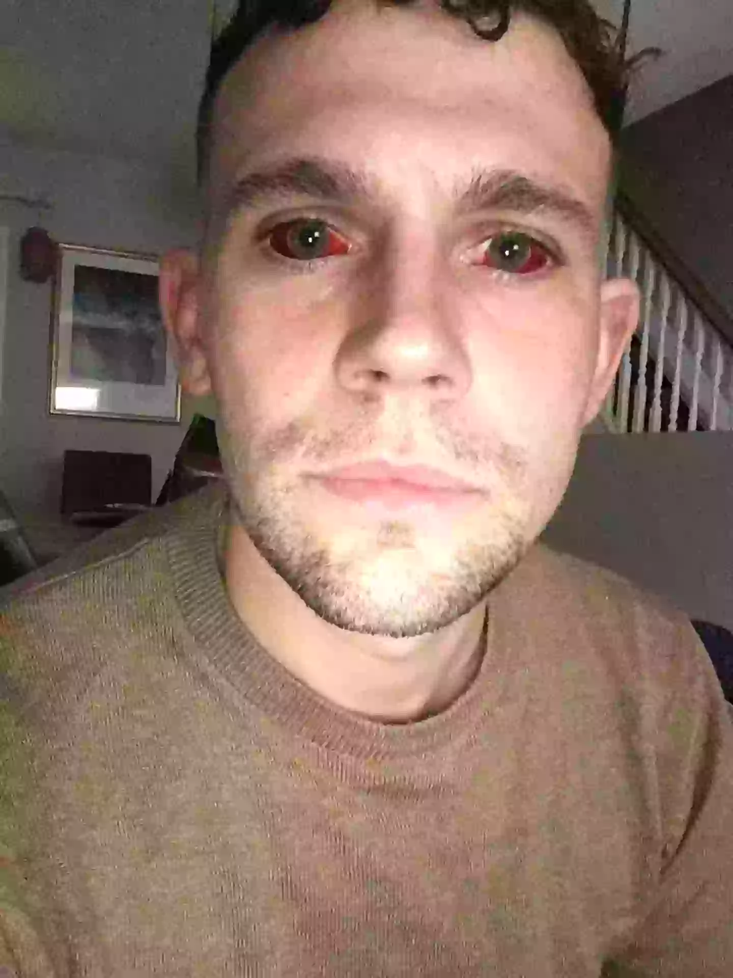 Dave was left with extremely bloodshot eyes (Kennedy News)
