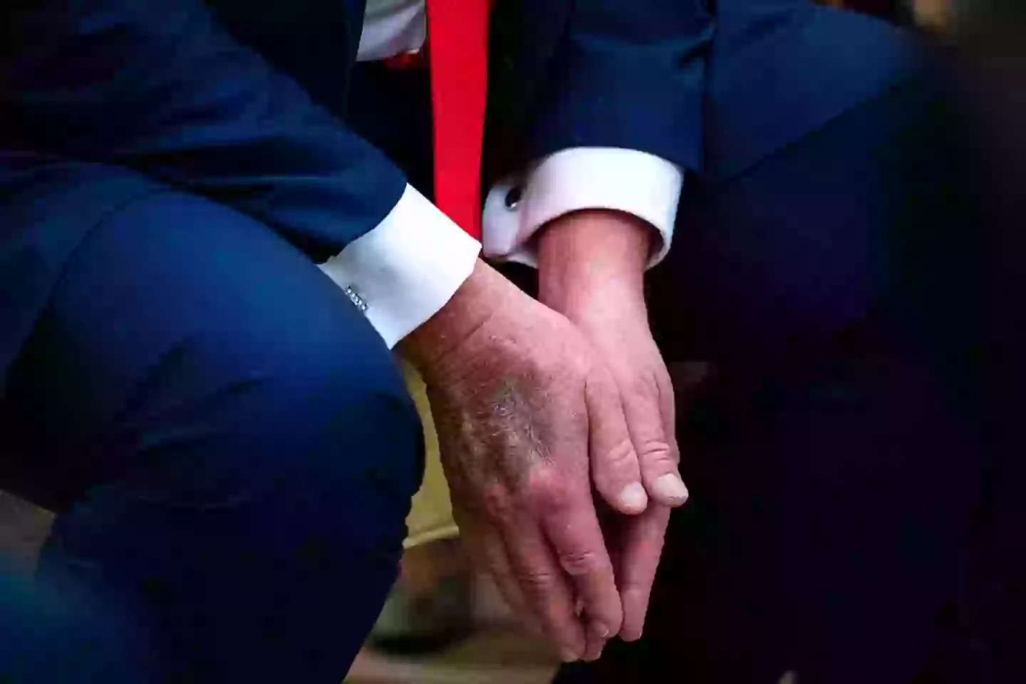Bruising could be seen on the back of Trump's right hand during a meeting with South Korean President Lee Jae Myung, last Monday (Al Drago/Bloomberg via Getty Images)