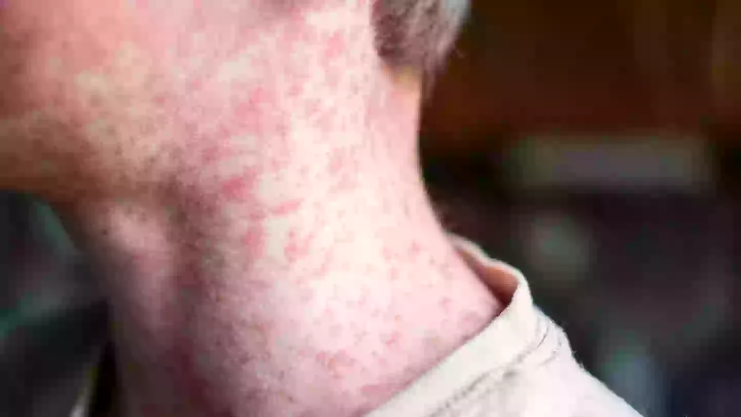 Everything to know about US measles outbreak as 2025 cases so far surpass numbers for whole of 2024