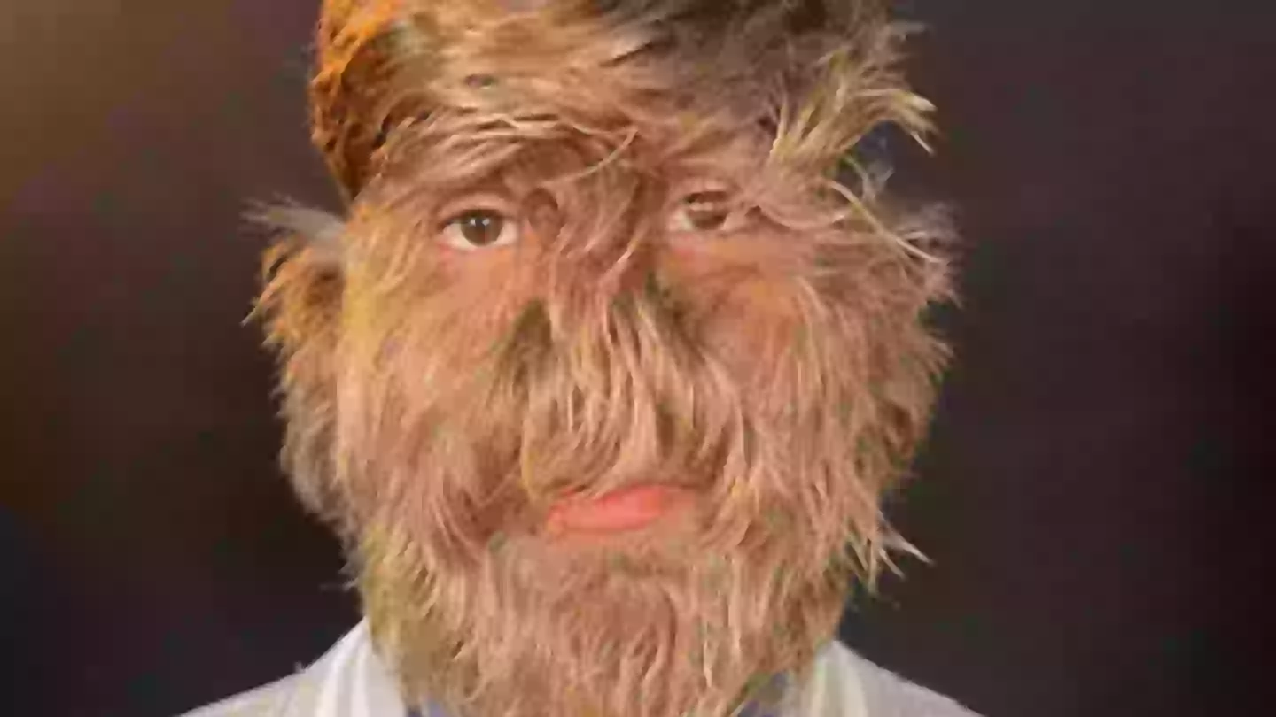 Teen diagnosed with 'one in 1,000,000,000' werewolf syndrome breaks world record for 'hairiest face'