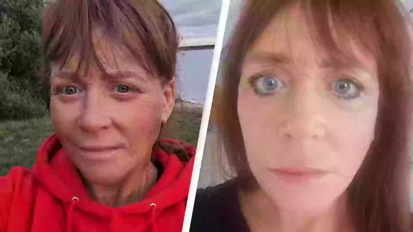 Woman reveals 'horror' surgery to fix her face after weight loss left her unable to close eyes even when she sleeps