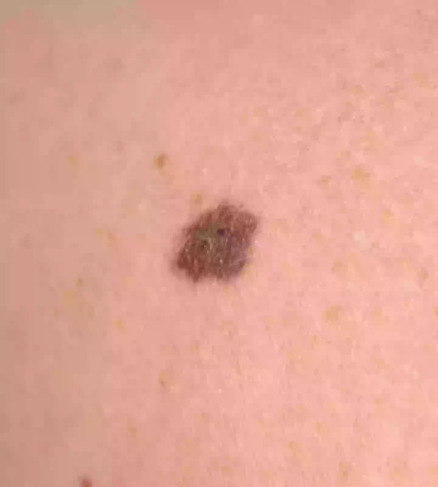 Doctors discovered that the mole was cancerous (Kennedy News and Media)