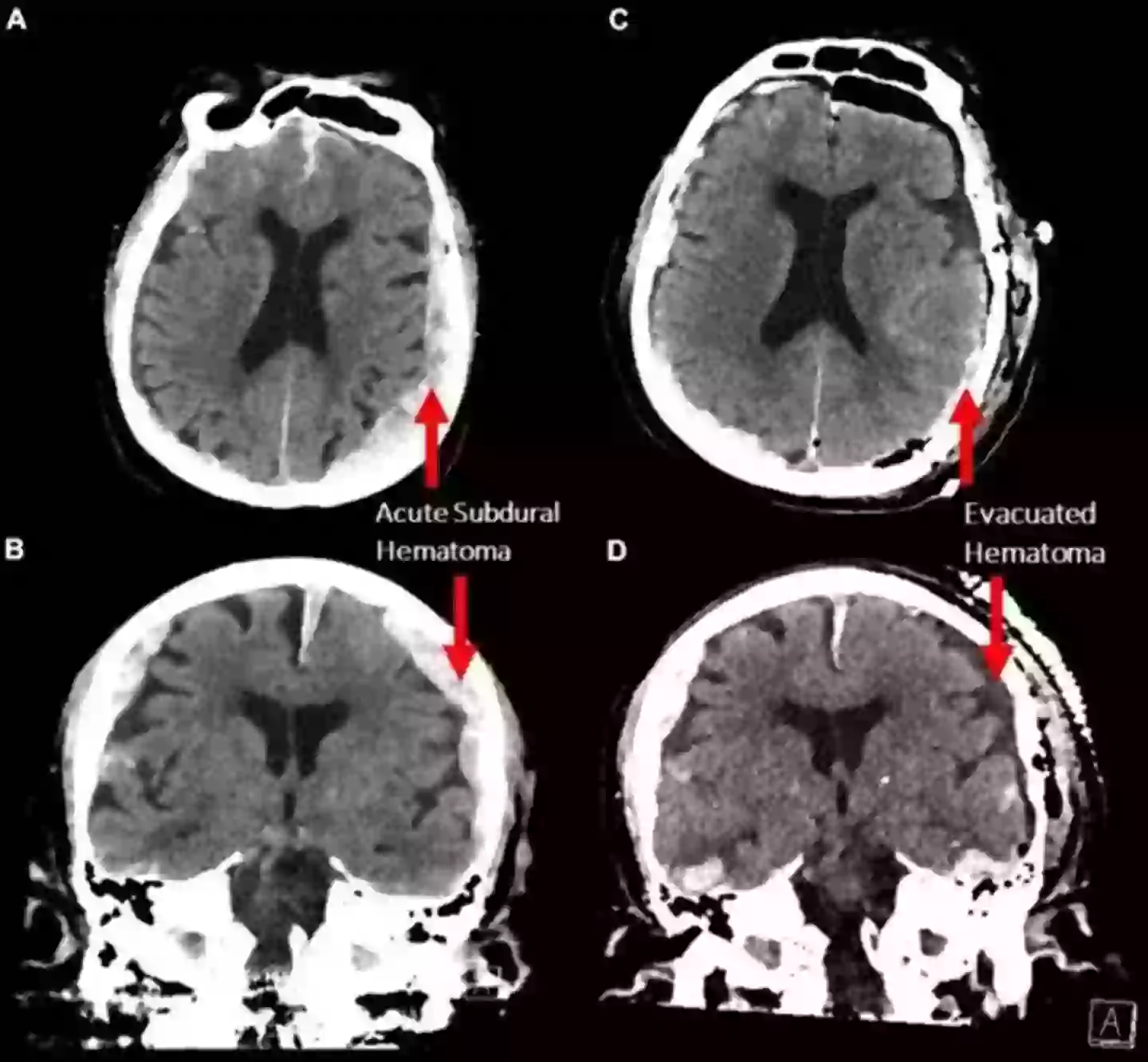Researchers examined a man's brain in the final moments before death (Frontiers in Ageing Neuroscience)