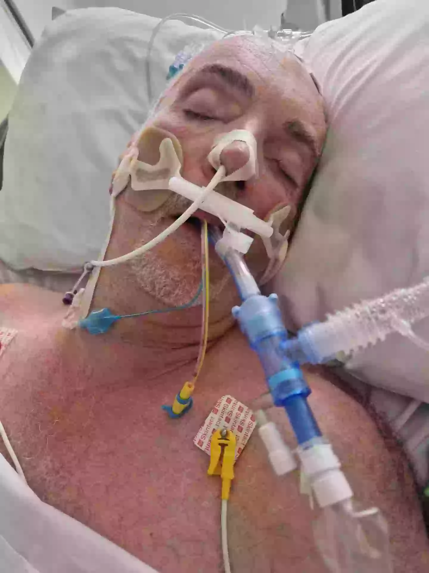 However the 67-year-old was left fighting for his life after developing Legionnaires (SWNS)