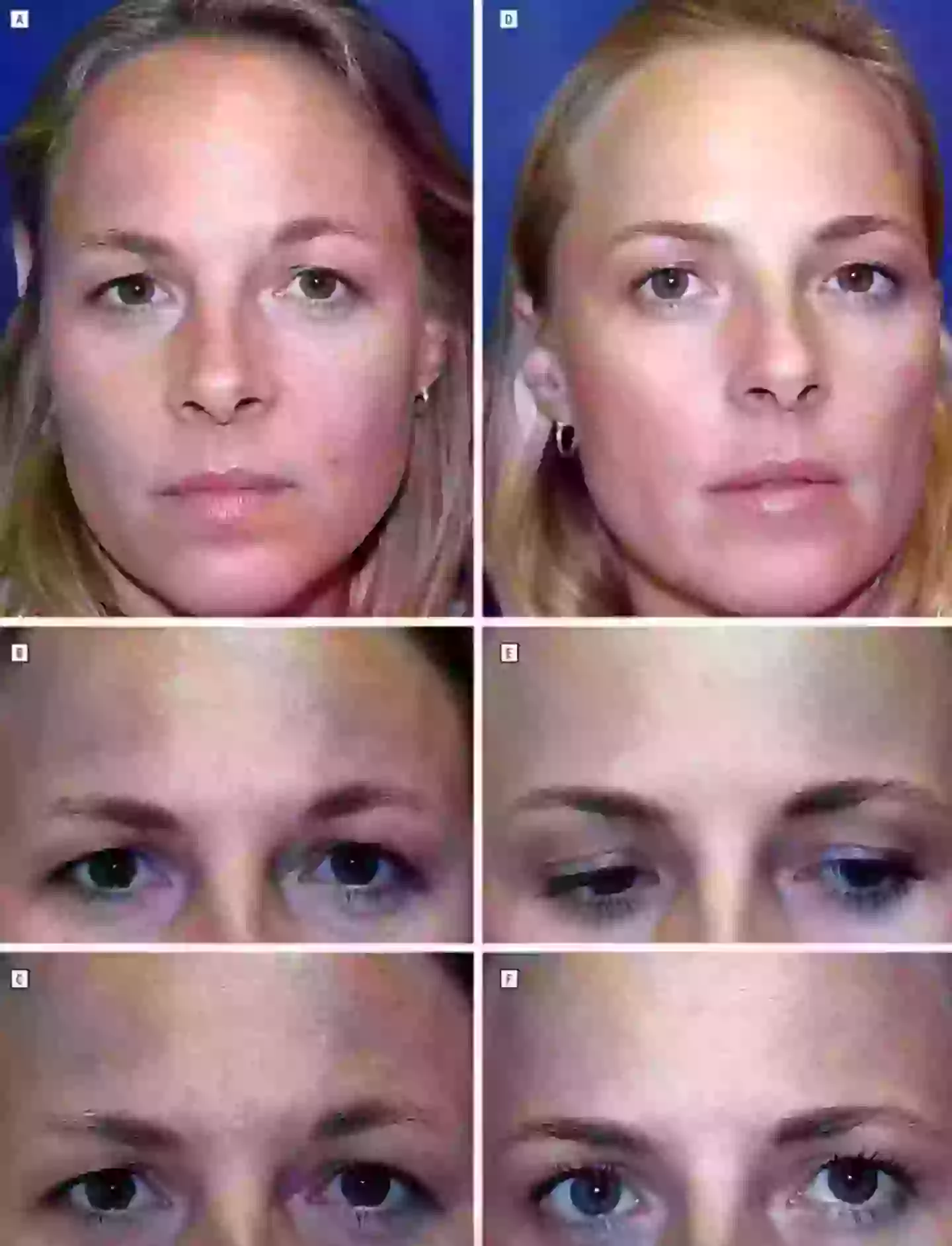 The twin on the right had regular botox injections (American Medical Association)