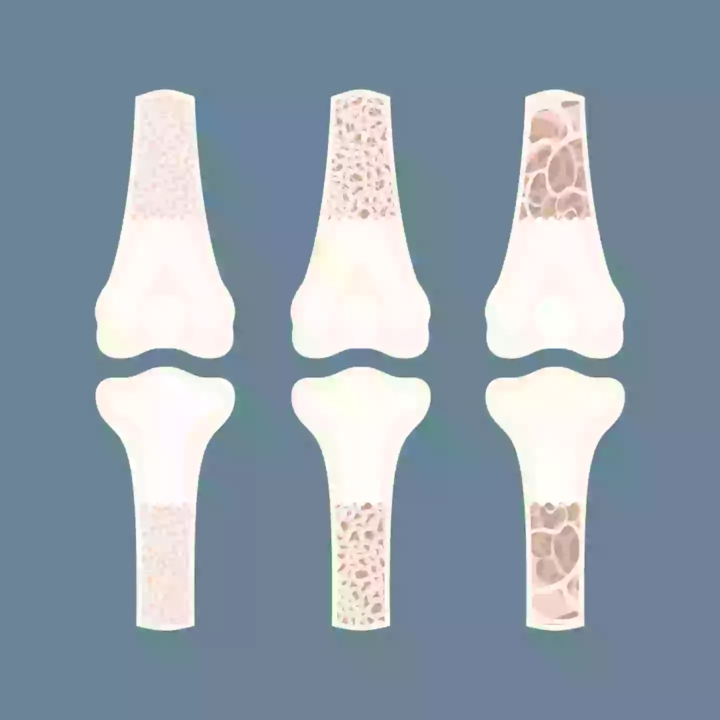 Bone density and skeleton size is impacted by genetics (Getty Stock Images)