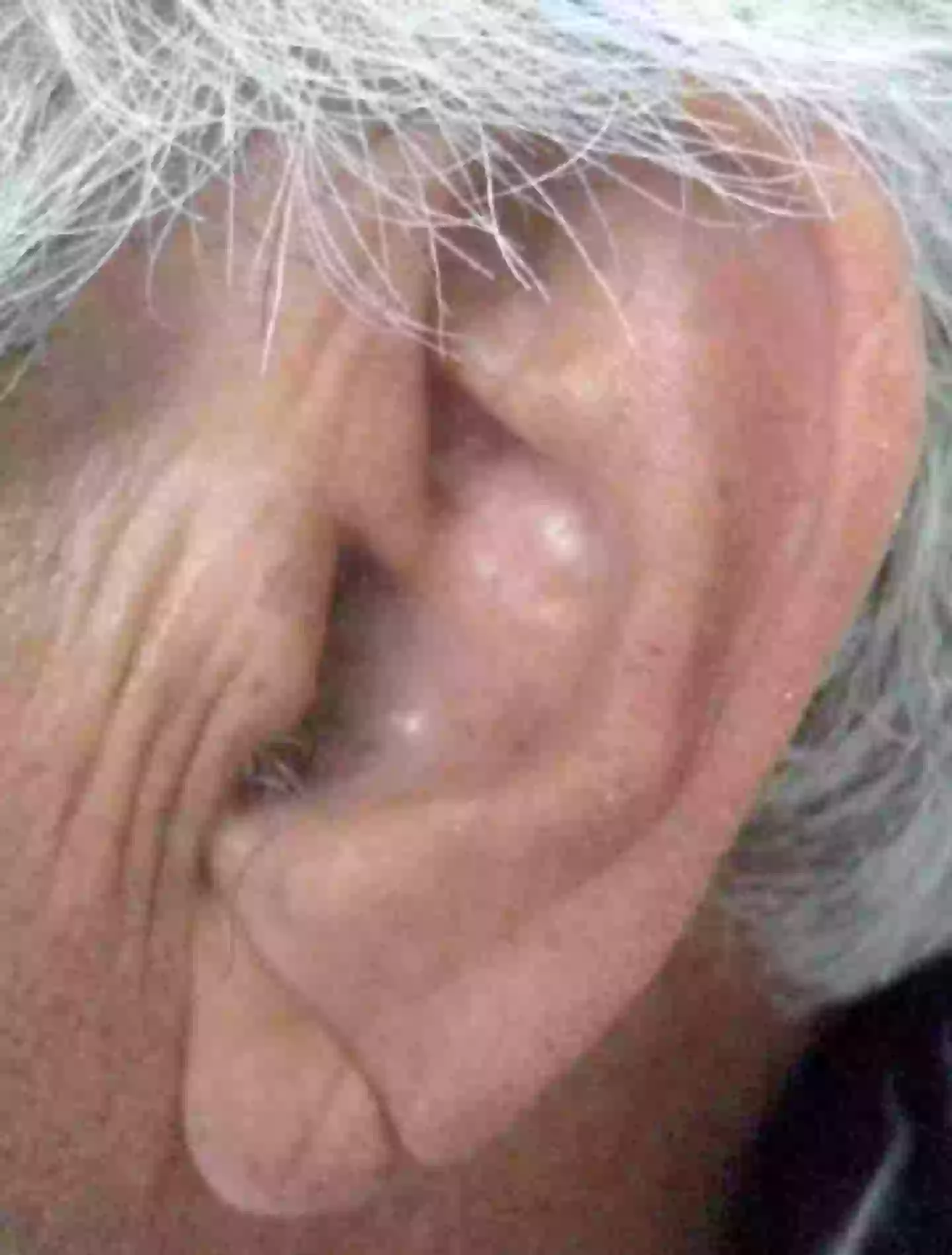 If you've got a crease in your earlobe, you could be at a greater risk of suffering from serious heart problems (Stanford Medicine)