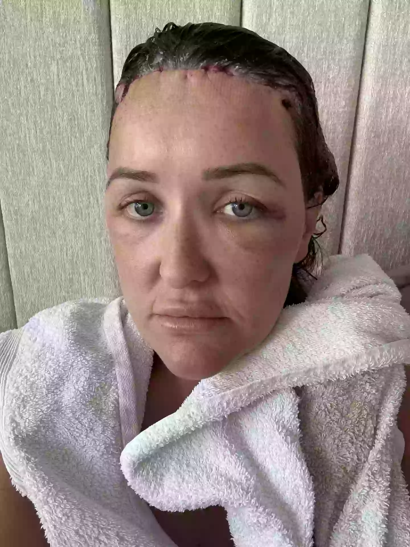 Essex mum Chloe Walker decided to get forehead reduction surgery after being 'self-conscious all my life' (Kennedy News and Media)