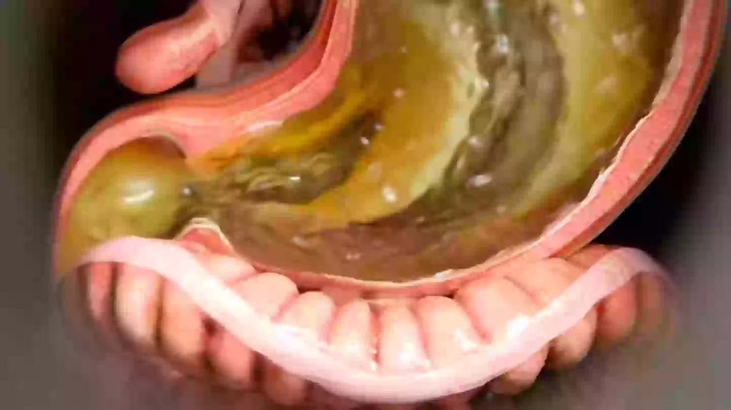 Doctors warn of brutal ‘Ozempic aftermath’ as simulation shows major effect it has on body