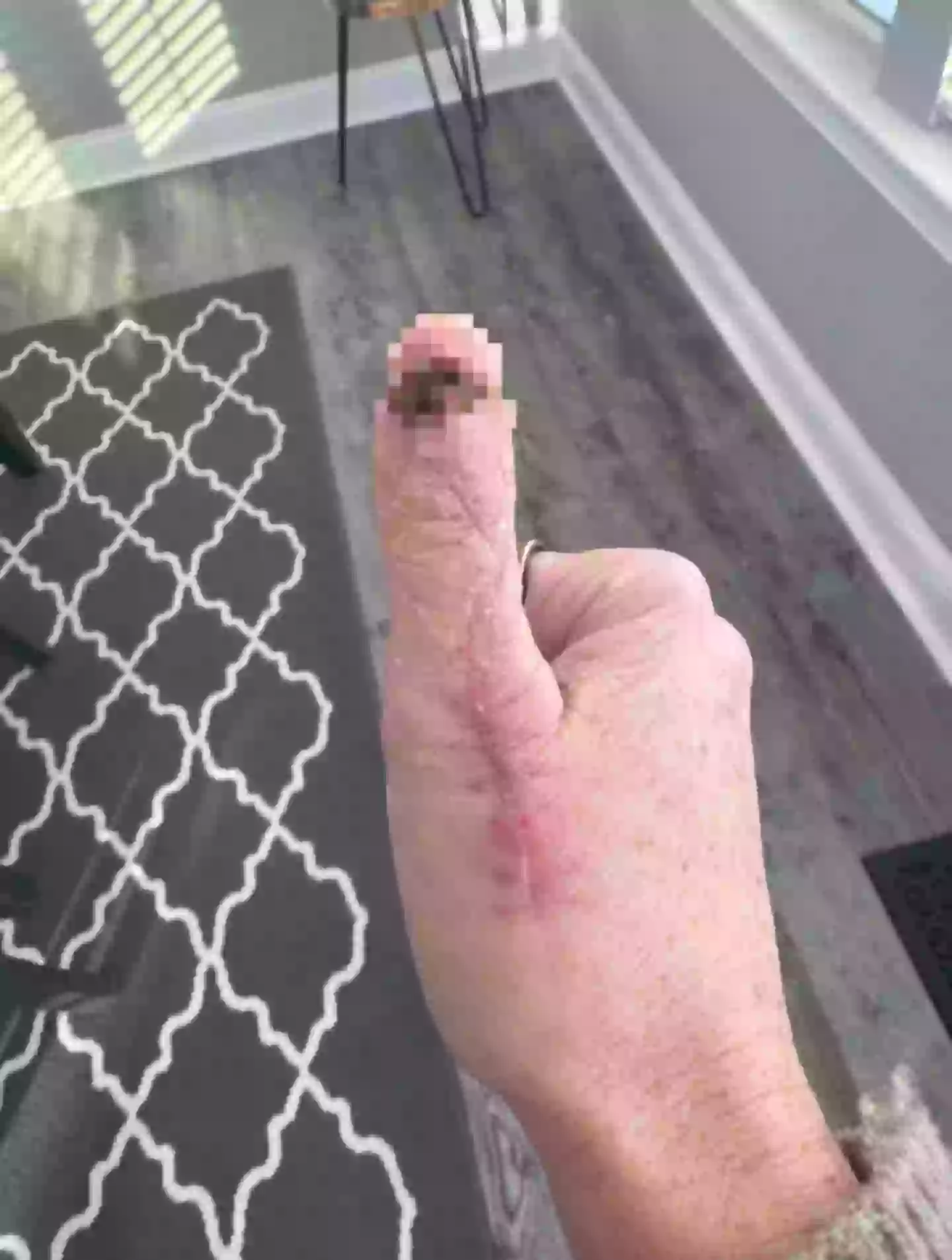 Michelle's post-surgery scar (Kennedy News and Media)