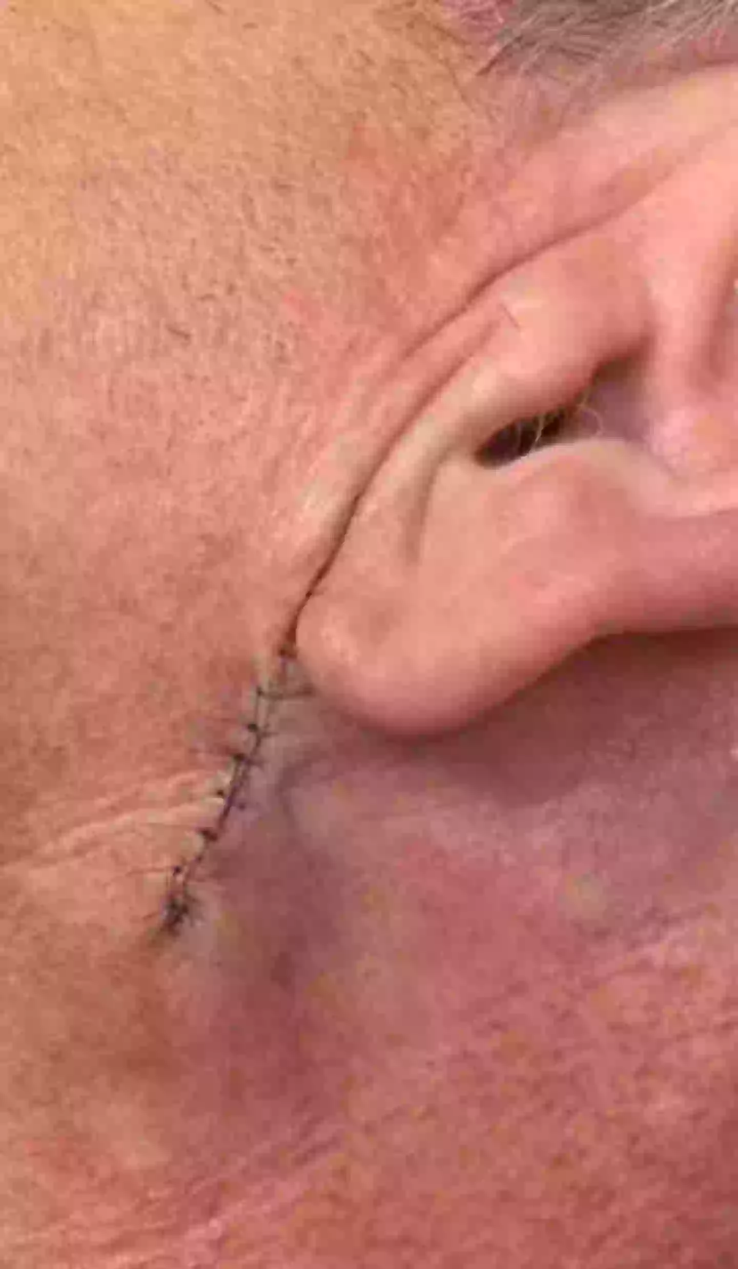 Ramsay said he underwent surgery to remove basal cell carcinoma (Instagram/@gordongram)