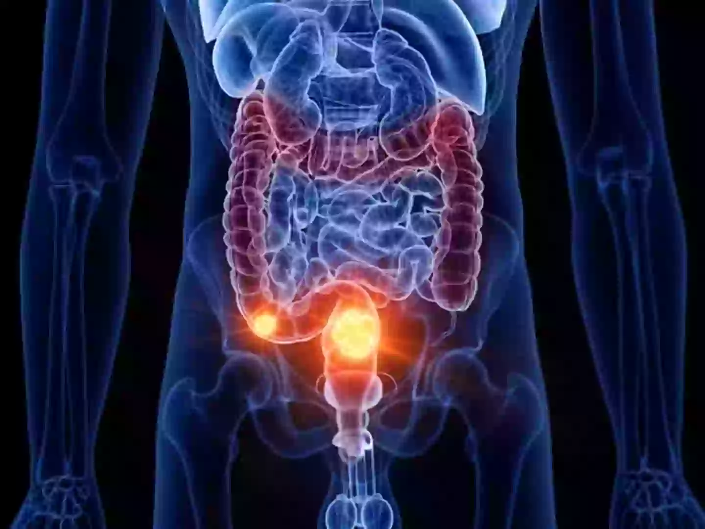 The condition has been linked to bowel cancer in UK youngsters (Getty Stock Image)