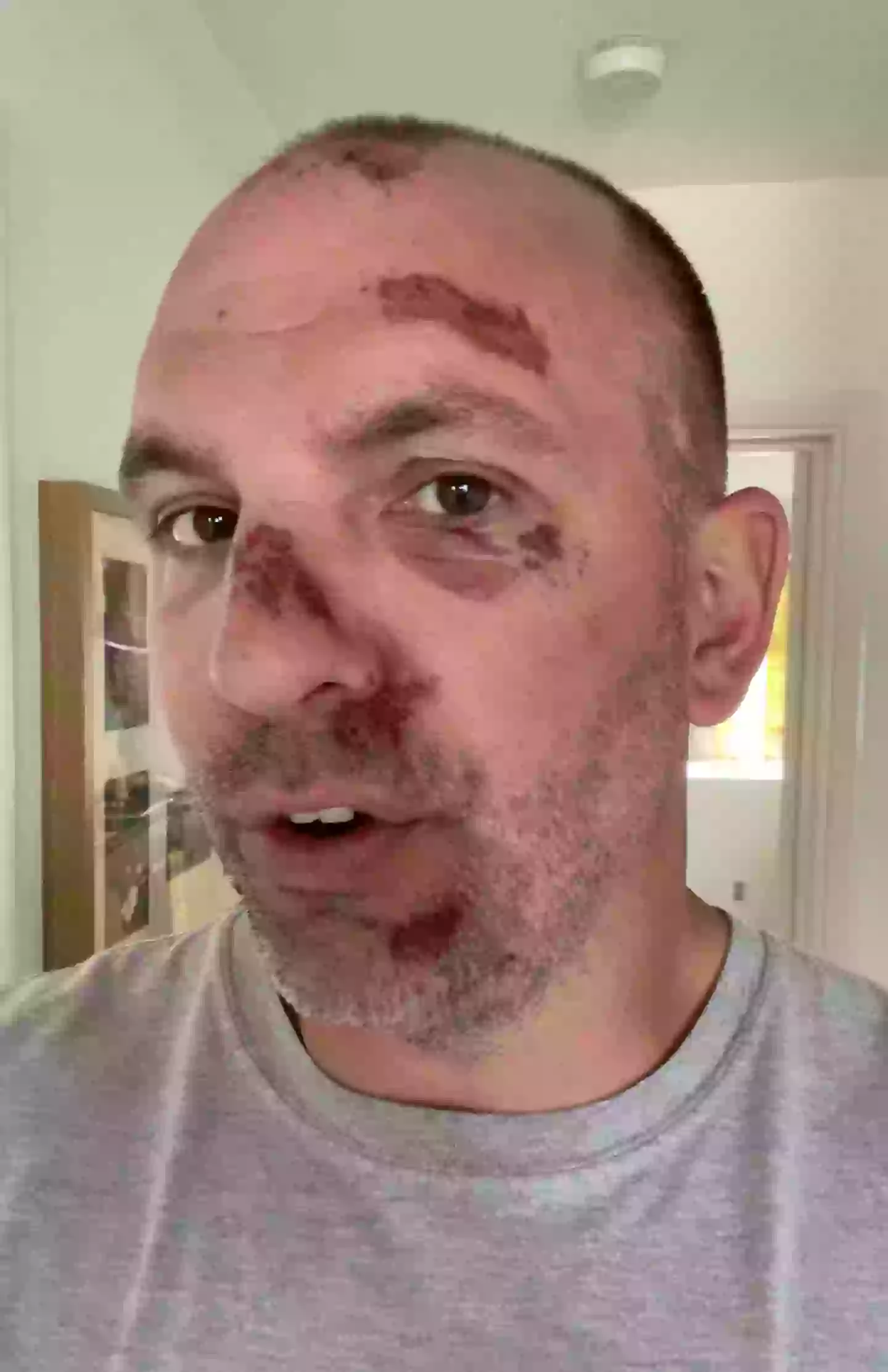 Richard Garbas said 'sod them' after his own e-scooter crash (Kennedy)