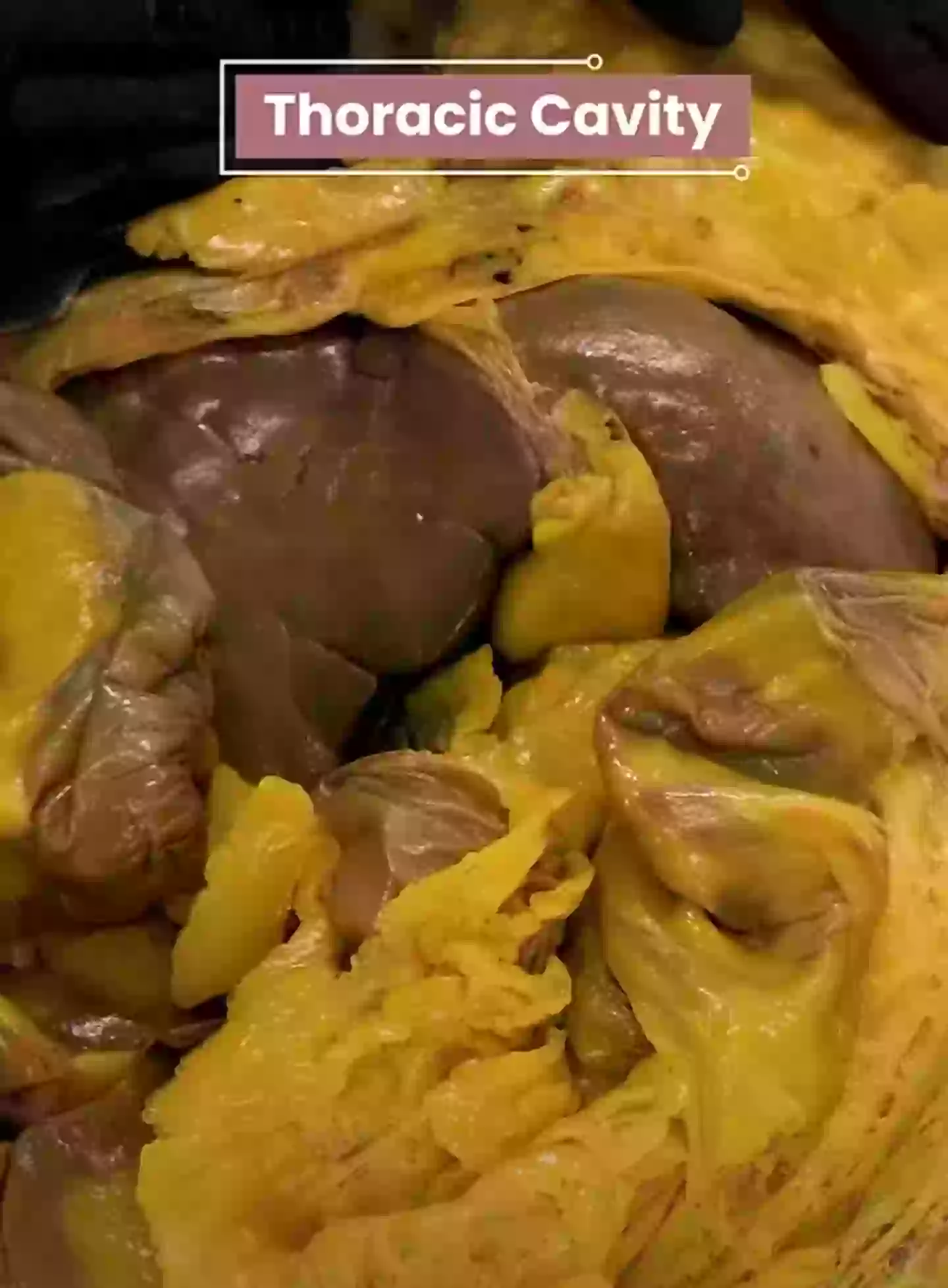 Fat can be seen engulfing the vital organs (YouTube/@theanatomylab)