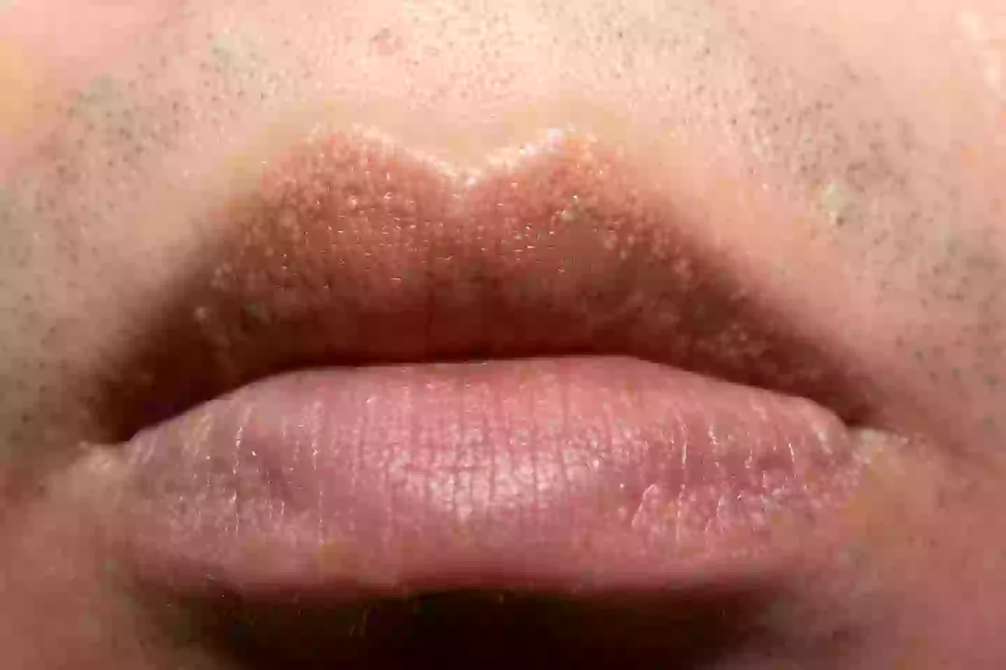Fordyce spots around the lips, they also occur in other places we won't show you pictures of (Getty Stock Photo)