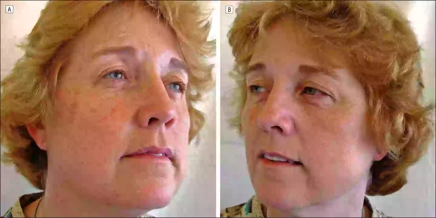 The non-smoker had a better score. (Arch Dermatol/JAMA Dermatology)