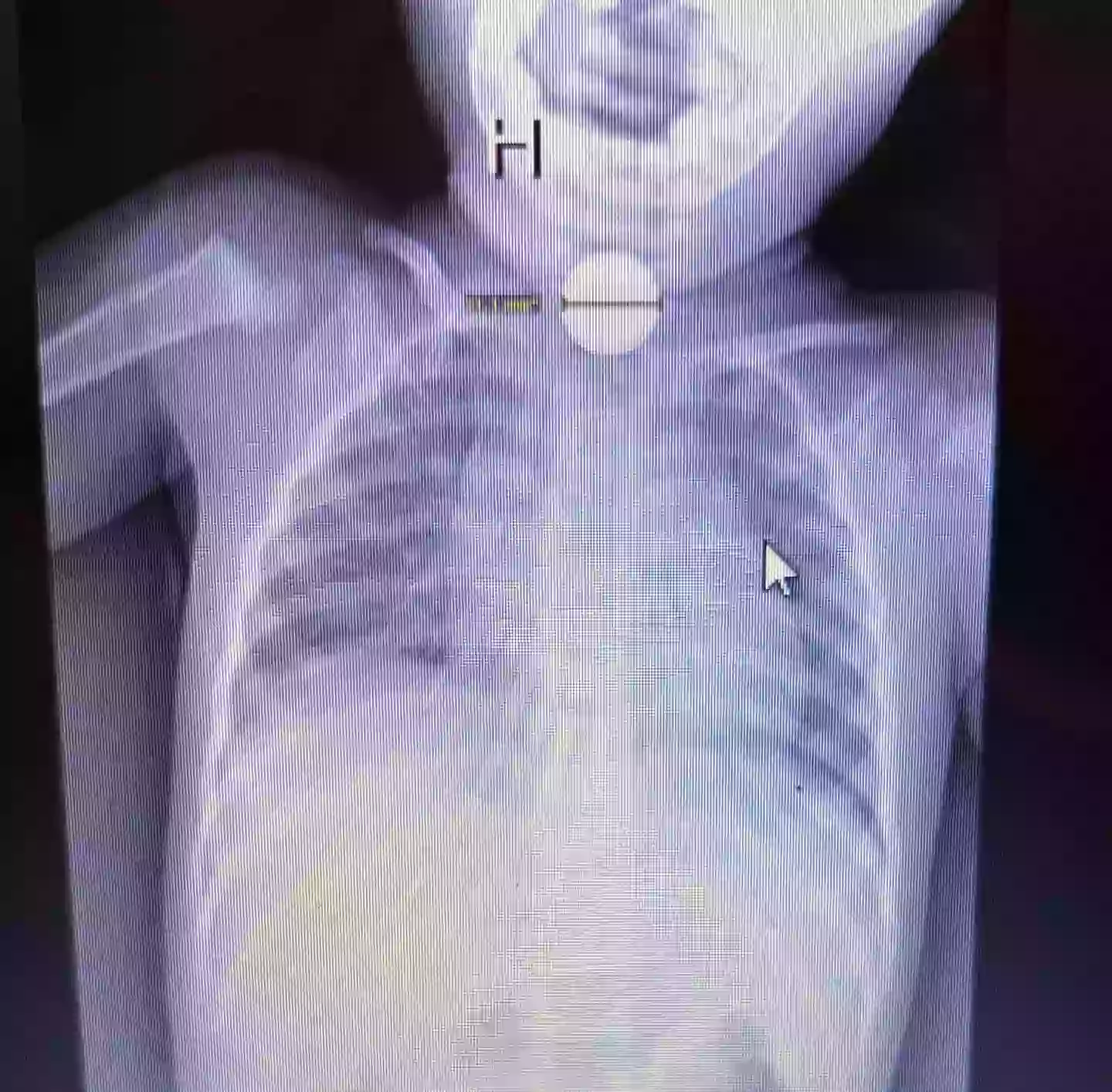 An X-ray discovered the button battery (Kennedy News and Media)