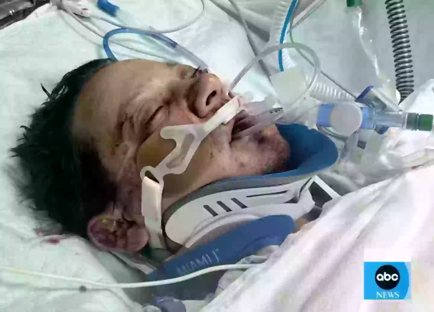 Renner recalled how his left eyeball 'violently burst out of his skull' after the orbital bone surrounding his eye socket was broken (ABC News)