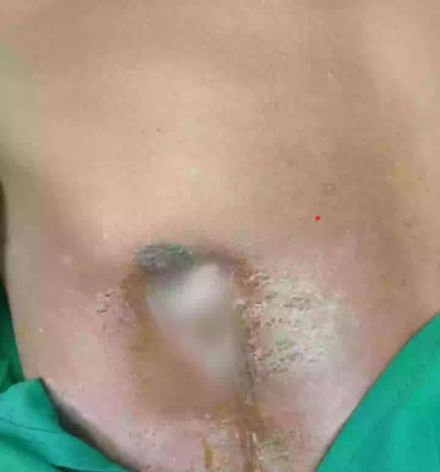 It wasn't a small amount of pus (National Library of Medicine)